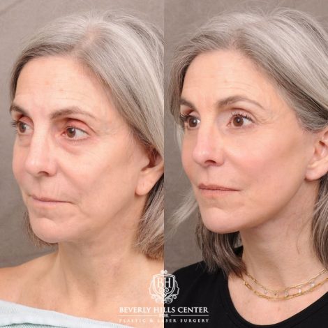Beverly Hills Center Female Patient Before and After AuraLyft, CUPID LIFT®, Brow Lift, Upper Blepharoplasty, Fat Grafting, and Earlobe Repair