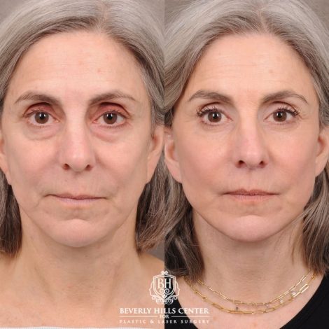 Beverly Hills Center Female Patient Before and After AuraLyft, CUPID LIFT®, Brow Lift, Upper Blepharoplasty, Fat Grafting, and Earlobe Repair