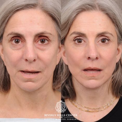Beverly Hills Center Female Patient Before and After AuraLyft, CUPID LIFT®, Brow Lift, Upper Blepharoplasty, Fat Grafting, and Earlobe Repair