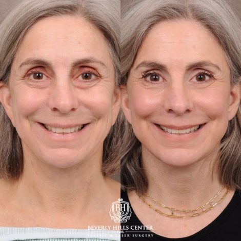 Beverly Hills Center Female Patient Before and After AuraLyft, CUPID LIFT®, Brow Lift, Upper Blepharoplasty, Fat Grafting, and Earlobe Repair