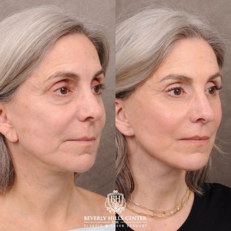 Beverly Hills Center Female Patient Before and After AuraLyft, CUPID LIFT®, Brow Lift, Upper Blepharoplasty, Fat Grafting, and Earlobe Repair