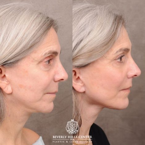 Beverly Hills Center Female Patient Before and After AuraLyft, CUPID LIFT®, Brow Lift, Upper Blepharoplasty, Fat Grafting, and Earlobe Repair