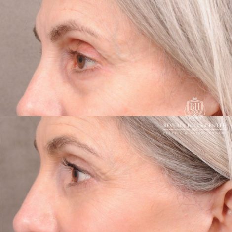 Beverly Hills Center Female Patient Before and After AuraLyft, CUPID LIFT®, Brow Lift, Upper Blepharoplasty, Fat Grafting, and Earlobe Repair