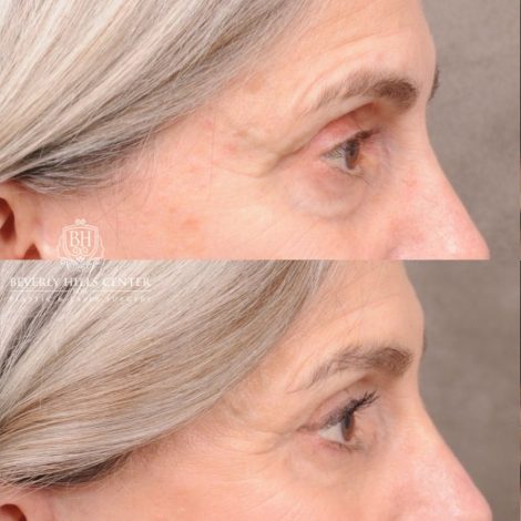 Beverly Hills Center Female Patient Before and After AuraLyft, CUPID LIFT®, Brow Lift, Upper Blepharoplasty, Fat Grafting, and Earlobe Repair