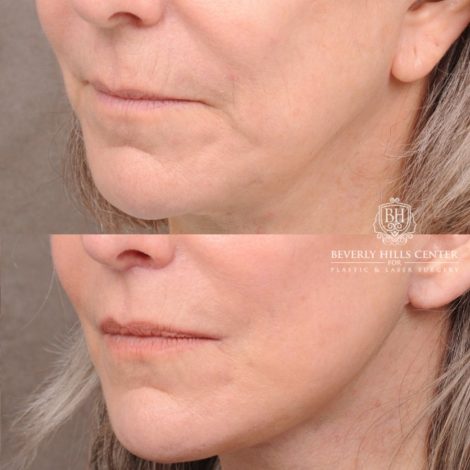 Beverly Hills Center Female Patient Before and After AuraLyft, CUPID LIFT®, Brow Lift, Upper Blepharoplasty, Fat Grafting, and Earlobe Repair