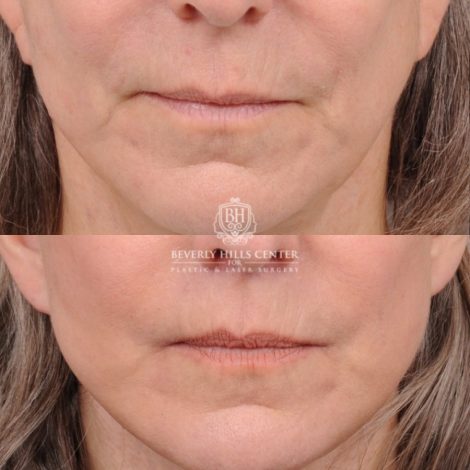 Beverly Hills Center Female Patient Before and After AuraLyft, CUPID LIFT®, Brow Lift, Upper Blepharoplasty, Fat Grafting, and Earlobe Repair