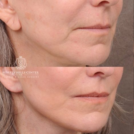 Beverly Hills Center Female Patient Before and After AuraLyft, CUPID LIFT®, Brow Lift, Upper Blepharoplasty, Fat Grafting, and Earlobe Repair