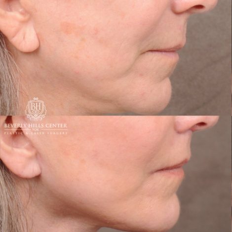 Beverly Hills Center Female Patient Before and After AuraLyft, CUPID LIFT®, Brow Lift, Upper Blepharoplasty, Fat Grafting, and Earlobe Repair
