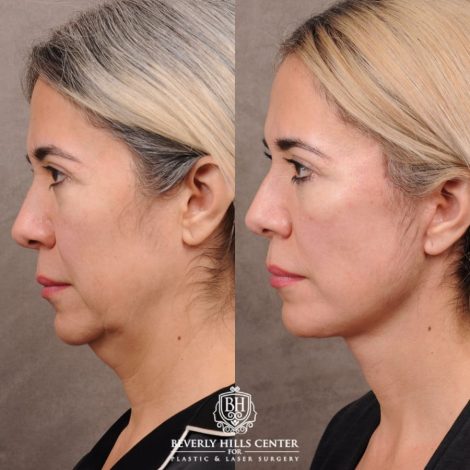 Beverly Hills Center Female Patient Before and After AuraLyft