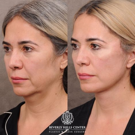 Beverly Hills Center Female Patient Before and After AuraLyft