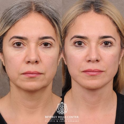 Beverly Hills Center Female Patient Before and After AuraLyft