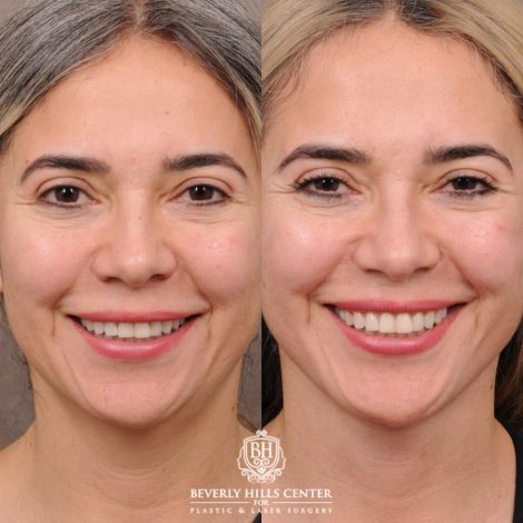 Beverly Hills Center Female Patient Before and After AuraLyft