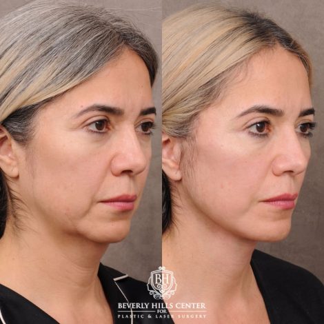 Beverly Hills Center Female Patient Before and After AuraLyft