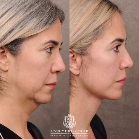 Beverly Hills Center Female Patient Before and After AuraLyft