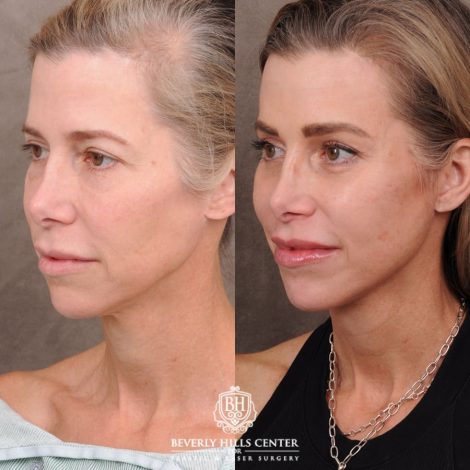 Beverly Hills Center Female Patient Before and After Comprehensive AuraLyft featuring the CUPID LIFT®, Minor Temporal Brow Reset, Upper & Lower Blepharoplasty