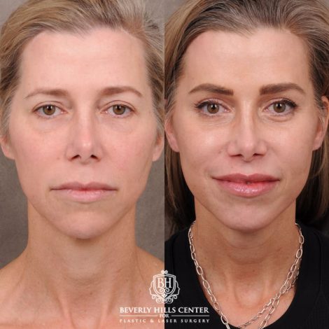 Beverly Hills Center Female Patient Before and After Comprehensive AuraLyft featuring the CUPID LIFT®, Minor Temporal Brow Reset, Upper & Lower Blepharoplasty