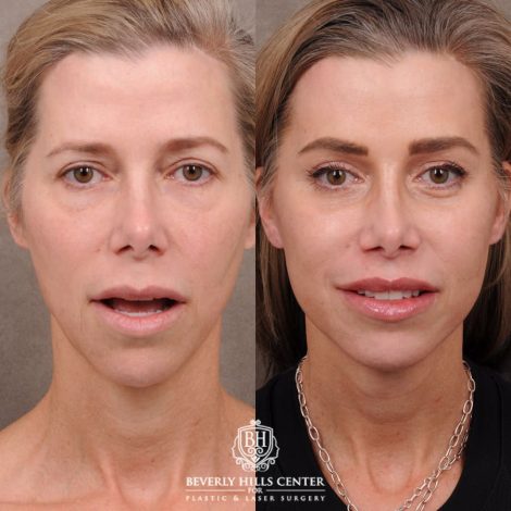 Beverly Hills Center Female Patient Before and After Comprehensive AuraLyft featuring the CUPID LIFT®, Minor Temporal Brow Reset, Upper & Lower Blepharoplasty