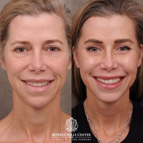 Beverly Hills Center Female Patient Before and After Comprehensive AuraLyft featuring the CUPID LIFT®, Minor Temporal Brow Reset, Upper & Lower Blepharoplasty