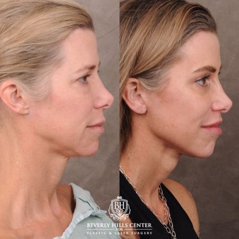Beverly Hills Center Female Patient Before and After Comprehensive AuraLyft featuring the CUPID LIFT®, Minor Temporal Brow Reset, Upper & Lower Blepharoplasty