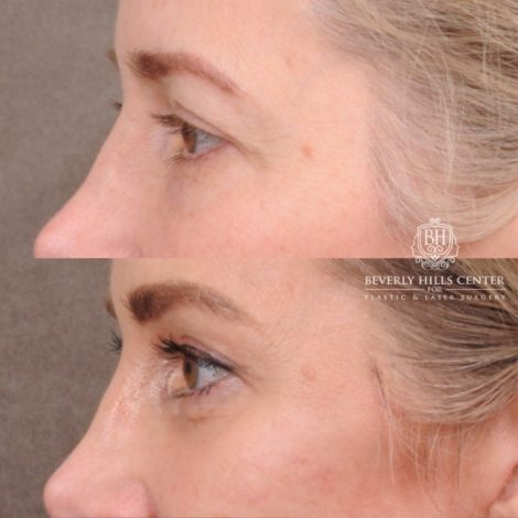 Beverly Hills Center Female Patient Before and After Comprehensive AuraLyft featuring the CUPID LIFT®, Minor Temporal Brow Reset, Upper & Lower Blepharoplasty
