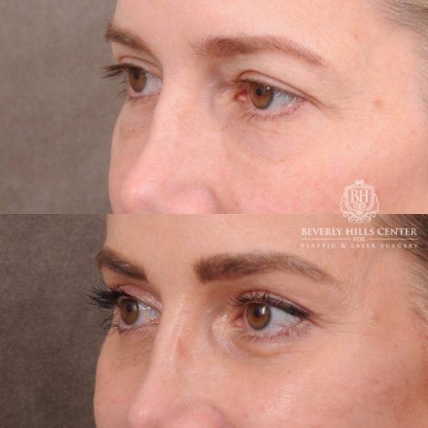 Beverly Hills Center Female Patient Before and After Comprehensive AuraLyft featuring the CUPID LIFT®, Minor Temporal Brow Reset, Upper & Lower Blepharoplasty