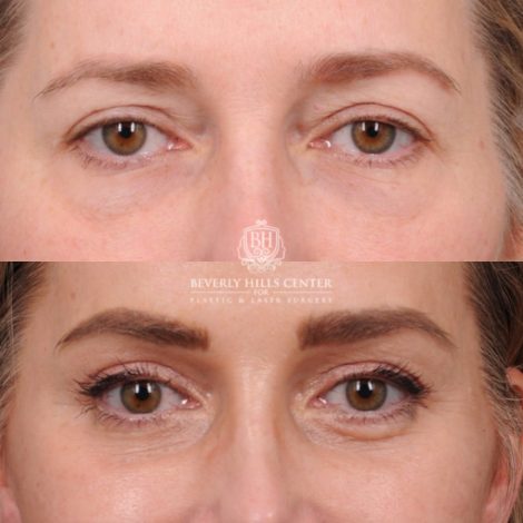 Beverly Hills Center Female Patient Before and After Comprehensive AuraLyft featuring the CUPID LIFT®, Minor Temporal Brow Reset, Upper & Lower Blepharoplasty