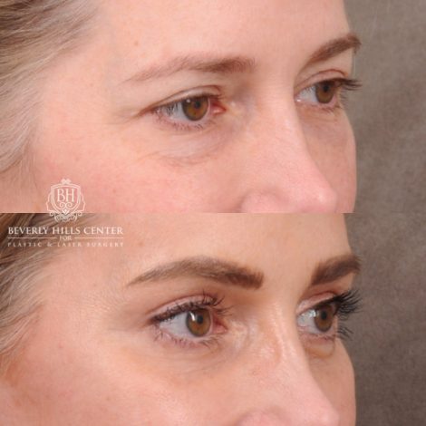 Beverly Hills Center Female Patient Before and After Comprehensive AuraLyft featuring the CUPID LIFT®, Minor Temporal Brow Reset, Upper & Lower Blepharoplasty