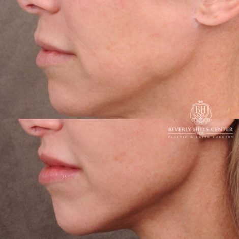 Beverly Hills Center Female Patient Before and After Comprehensive AuraLyft featuring the CUPID LIFT®, Minor Temporal Brow Reset, Upper & Lower Blepharoplasty