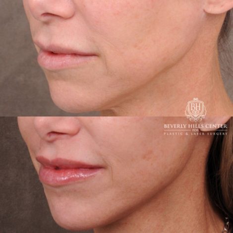 Beverly Hills Center Female Patient Before and After Comprehensive AuraLyft featuring the CUPID LIFT®, Minor Temporal Brow Reset, Upper & Lower Blepharoplasty