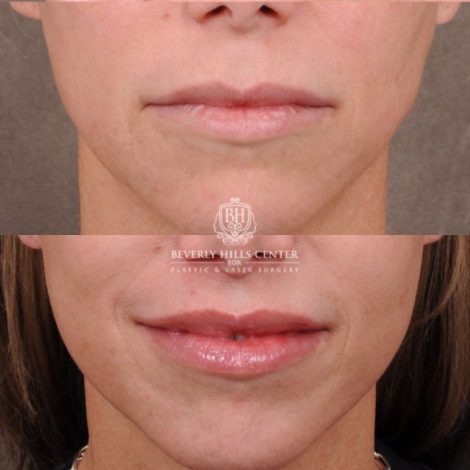 Beverly Hills Center Female Patient Before and After Comprehensive AuraLyft featuring the CUPID LIFT®, Minor Temporal Brow Reset, Upper & Lower Blepharoplasty