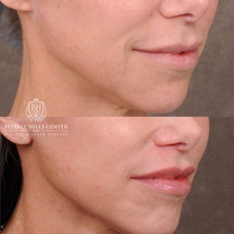 Beverly Hills Center Female Patient Before and After Comprehensive AuraLyft featuring the CUPID LIFT®, Minor Temporal Brow Reset, Upper & Lower Blepharoplasty