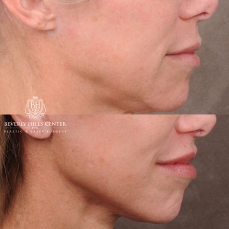 Beverly Hills Center Female Patient Before and After Comprehensive AuraLyft featuring the CUPID LIFT®, Minor Temporal Brow Reset, Upper & Lower Blepharoplasty