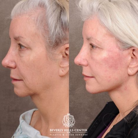 Beverly Hills Center Female Patient Before and After AuraLyft, Upper Blepharoplasty