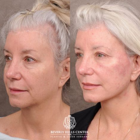 Beverly Hills Center Female Patient Before and After AuraLyft, Upper Blepharoplasty