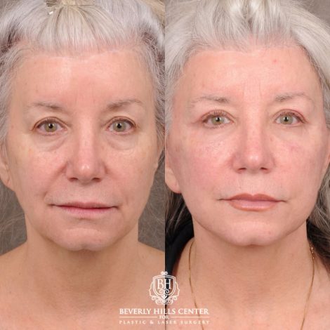 Beverly Hills Center Female Patient Before and After AuraLyft, Upper Blepharoplasty