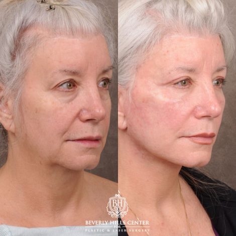 Beverly Hills Center Female Patient Before and After AuraLyft, Upper Blepharoplasty