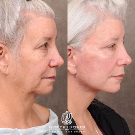 Beverly Hills Center Female Patient Before and After AuraLyft, Upper Blepharoplasty