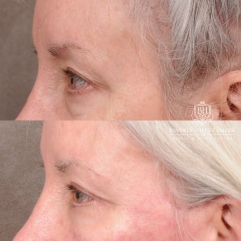 Beverly Hills Center Female Patient Before and After AuraLyft, Upper Blepharoplasty