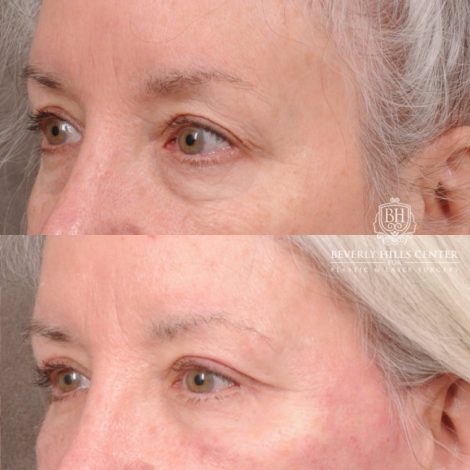 Beverly Hills Center Female Patient Before and After AuraLyft, Upper Blepharoplasty
