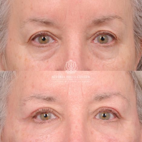 Beverly Hills Center Female Patient Before and After AuraLyft, Upper Blepharoplasty