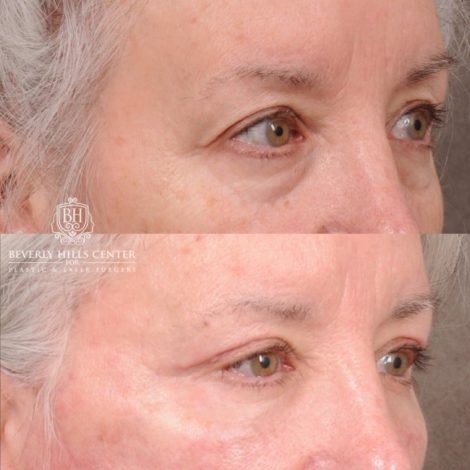 Beverly Hills Center Female Patient Before and After AuraLyft, Upper Blepharoplasty
