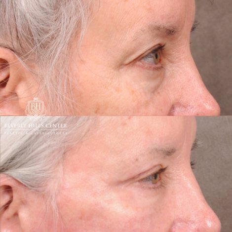 Beverly Hills Center Female Patient Before and After AuraLyft, Upper Blepharoplasty