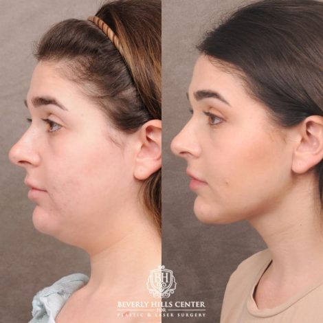 Beverly Hills Center Female Patient Before and After Weekend Necklift
