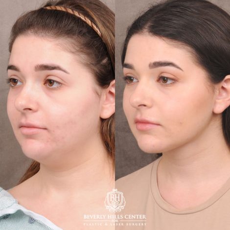 Beverly Hills Center Female Patient Before and After Weekend Necklift