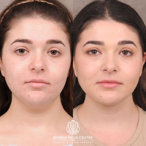 Beverly Hills Center Female Patient Before and After Weekend Necklift