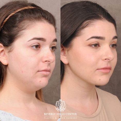 Beverly Hills Center Female Patient Before and After Weekend Necklift