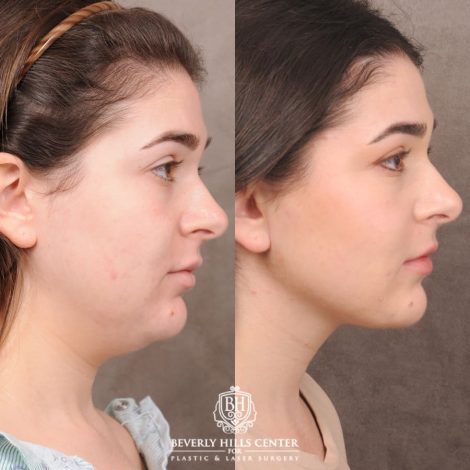 Beverly Hills Center Female Patient Before and After Weekend Necklift