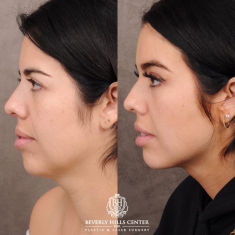 Beverly Hills Center Female Patient Before and After Brow Lift, Profound RF, Nanofat PRP