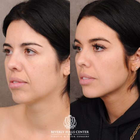 Beverly Hills Center Female Patient Before and After Brow Lift, Profound RF, Nanofat PRP