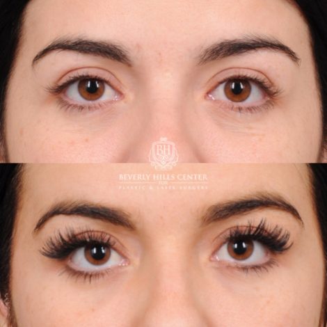Beverly Hills Center Female Patient Before and After Brow Lift, Profound RF, Nanofat PRP